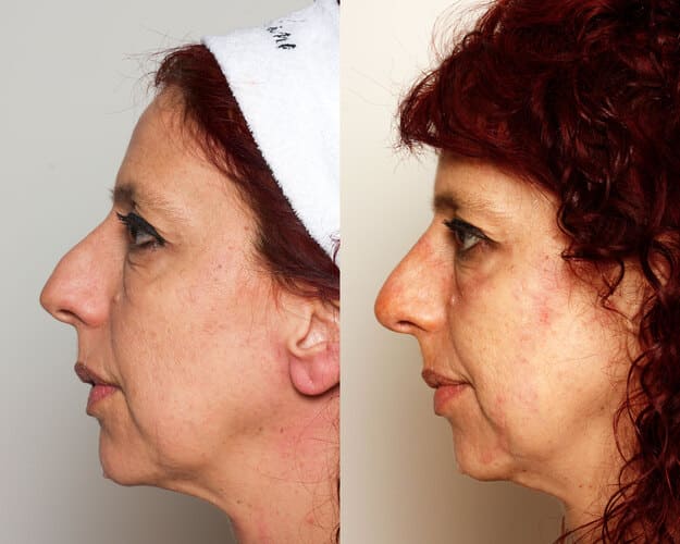 Antes y después 1