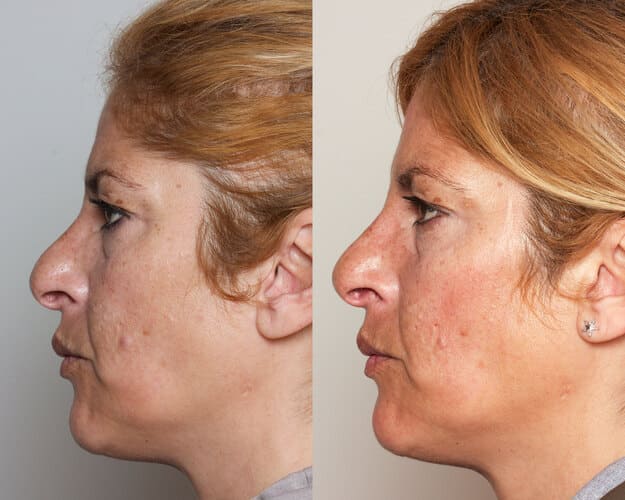 Antes y después 2